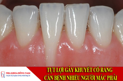 tụt lợi gây khuyết cổ răng - căn bệnh nhiều người mắc phải