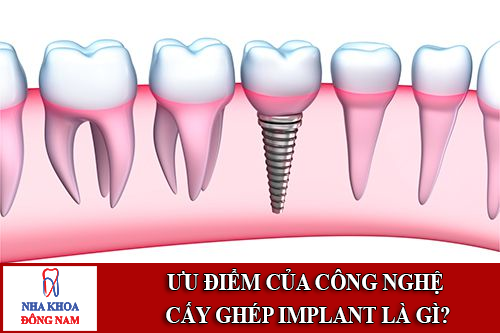 ưu điểm của công nghệ cấy ghép implant là gì