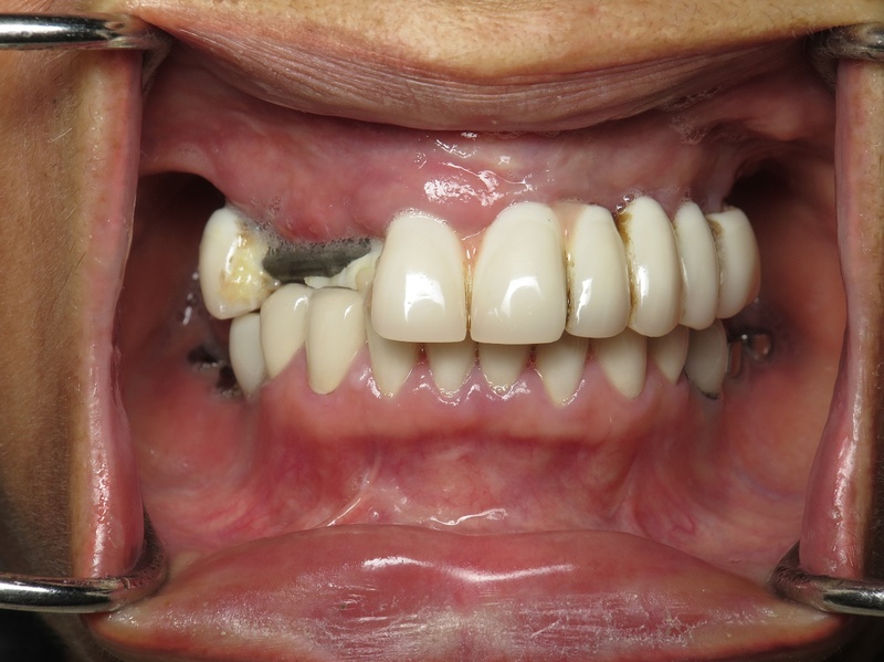 Vật sứ kém chất lượng ảnh hưởng đến độ bền răng sứ