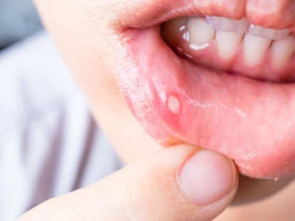 vết loét nhiệt miệng