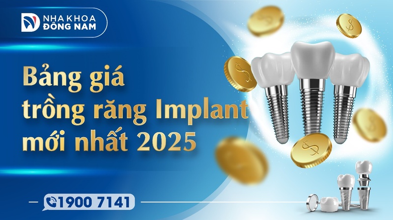 Bảng giá Implant mới nhất 2025 tại Nha Khoa Đông Nam