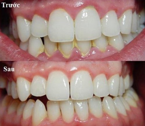 cạo vôi răng ngăn ngừa nha chu