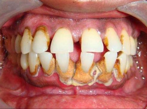 bệnh đau răng ở người già 2