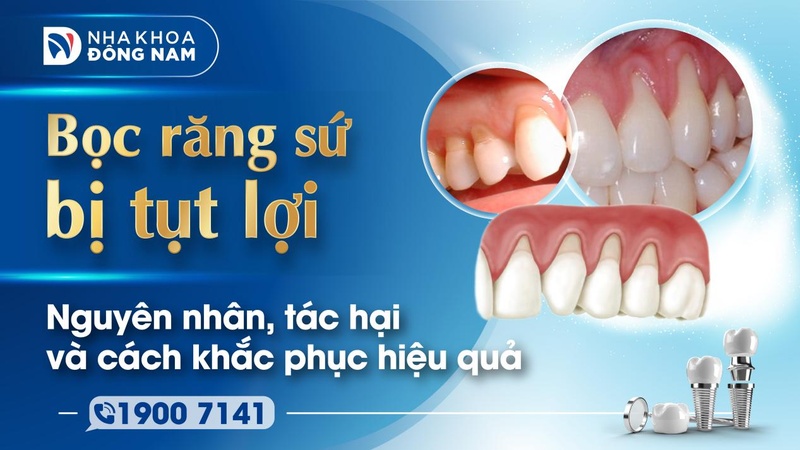 Bọc răng sứ bị tụt lợi
