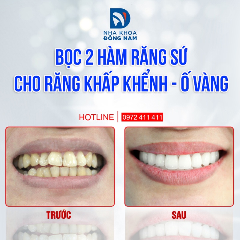 Bọc răng sứ cho răng khấp khểnh, ố vàng