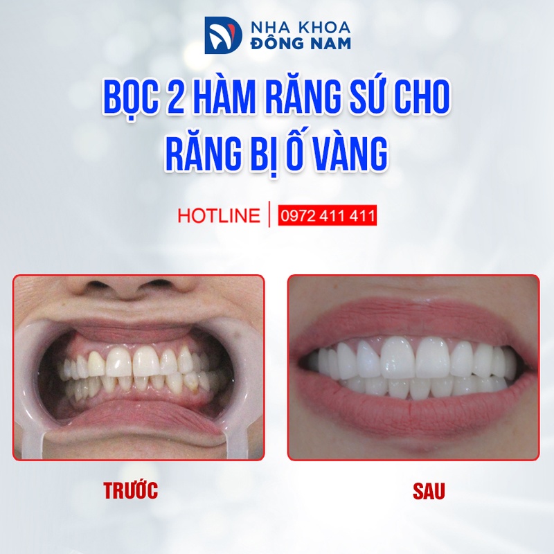 Bọc răng sứ cho răng ố vàng
