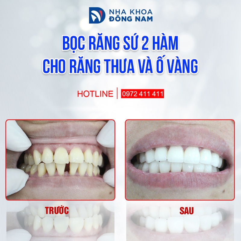 Bọc răng sứ cho răng thưa, ố vàng