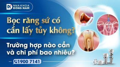 Bọc răng sứ có cần lấy tủy không Trường hợp nào cần và chi phí bao nhiêu?