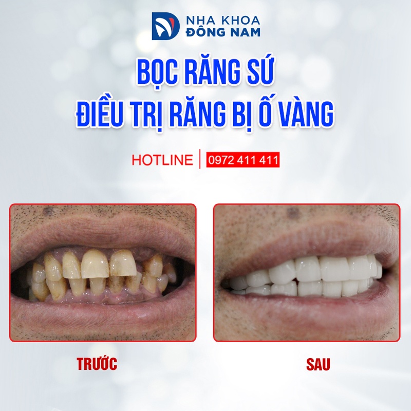 Bọc răng sứ điều trị răng ố vàng do thuốc lá