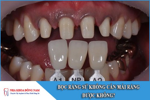 bọc răng sứ không cần mài răng được không