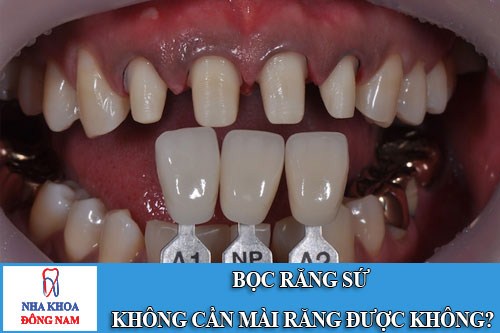 bọc răng sứ không cần mài răng được không