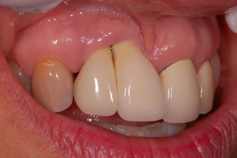 Bọc răng sứ sai cách gây đau nhức kéo dài
