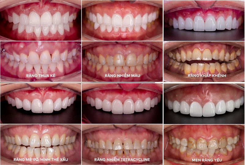 Các trường hợp có thể bọc răng sứ để cải thiện thẩm mỹ và chức năng ăn nhai