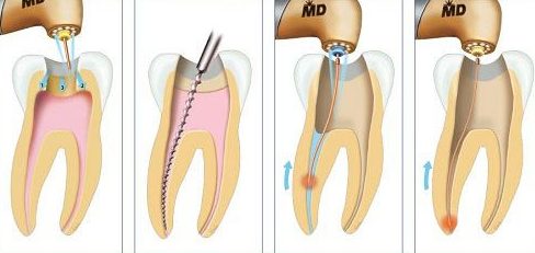 Káº¿t quáº£ hÃ¬nh áº£nh cho quy trÃ¬nh chá»¯a tá»§y rÄƒng