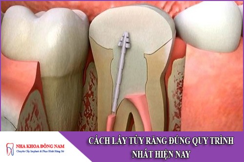 cách lấy tủy răng đúng quy trình nhất hiện nay