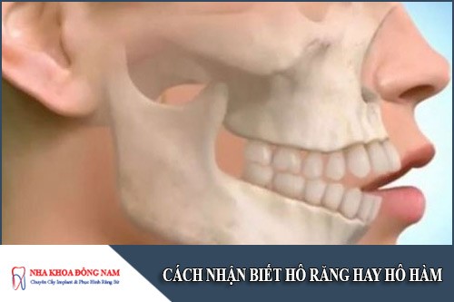 cách nhận biết hô răng hay hô hàm