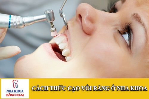 cách thức cạo vôi răng ở nha khoa