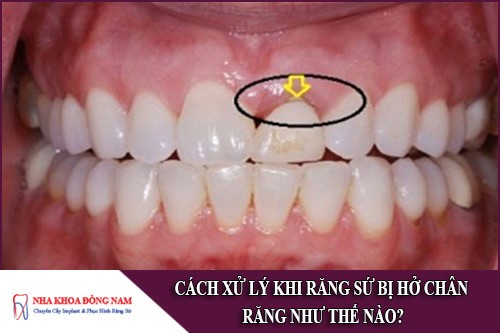 cách xử lý khi răng sứ bị hở chân răng như thế nào