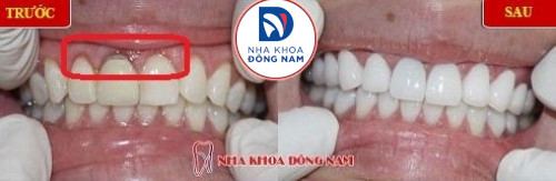 phục hình răng sứ mới cho răng sứ bị hở chân