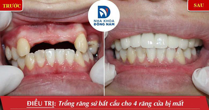 Cầu răng sứ cải thiện thẩm mỹ, ăn nhai tương đối tốt