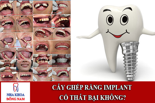cấy ghép răng implant có thất bại không