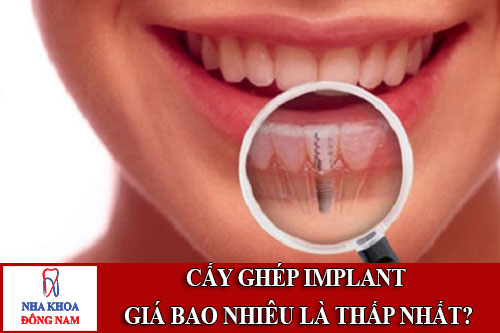 cấy ghép implant giá bao nhiêu là thấp nhất?
