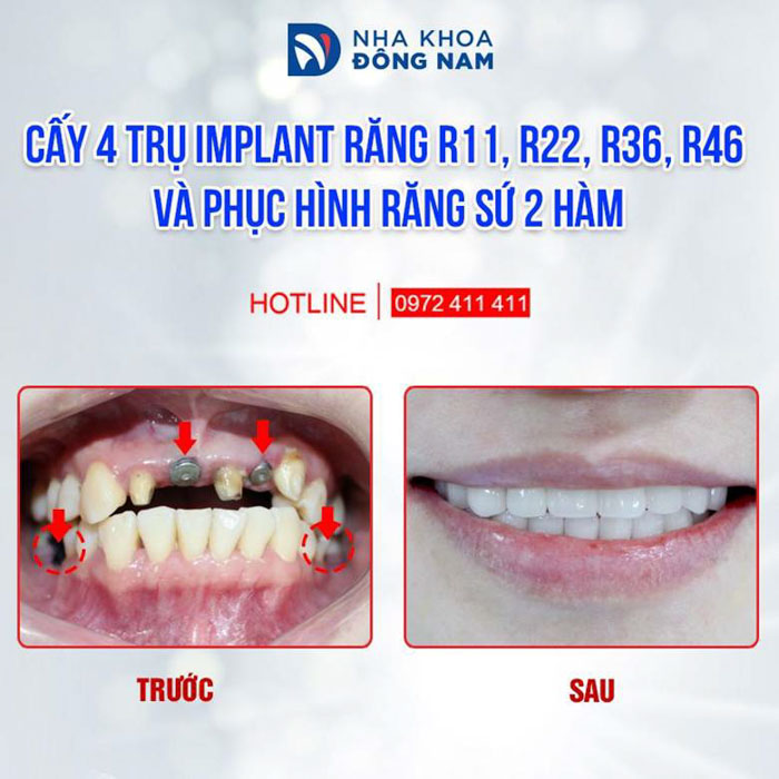 Cấy ghép Implant là phương pháp trồng răng giả tốt nhất được khuyên dùng