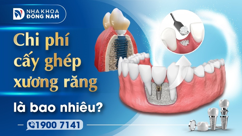 Chi phí cấy ghép xương răng là bao nhiêu