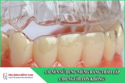 có nên sử dụng niềng răng tháo lắp cho người lớn không