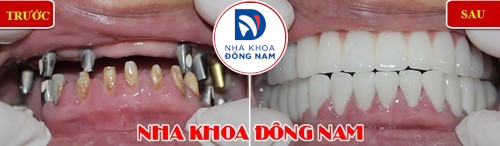 cấy ghép răng implant nguyên hàm