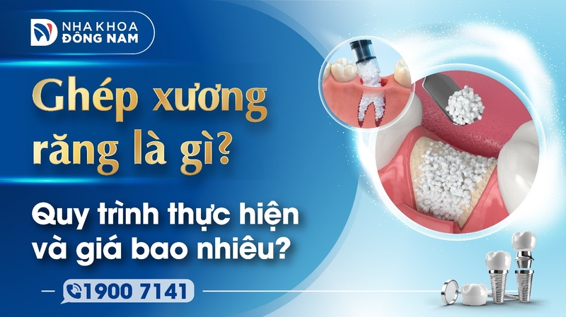Ghép xương răng quy trình và chi phí
