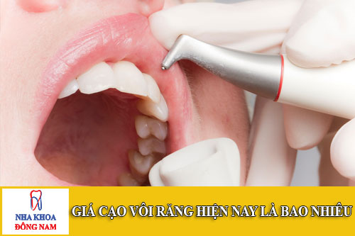 giá cạo vôi răng hiện nay là bao nhiêu