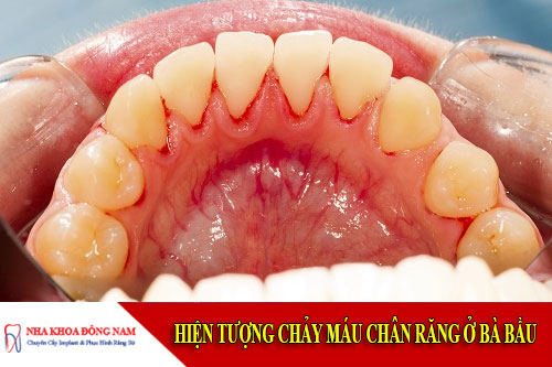 hiện tượng chảy máu chân răng ở bà bầu