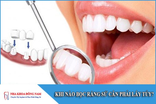 khi nào bọc răng sứ cần phải lấy tủy