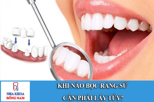 khi nào bọc răng sứ cần phải lấy tủy