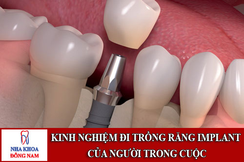 kinh nghiệm đi trồng răng implant của người trong cuộc