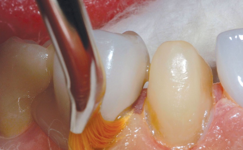 Mão sứ đã tháo ra mất đi độ khít sát ban đầu