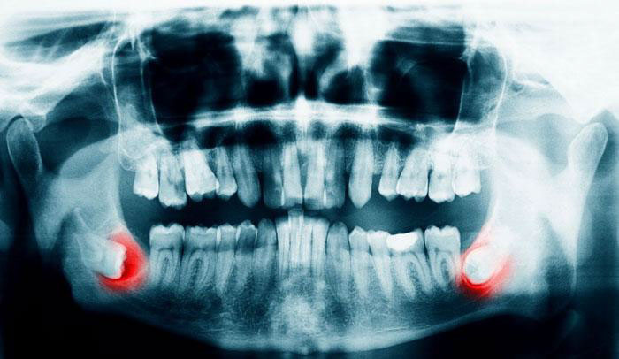 Mọc răng khôn là một trong các vấn đề về răng miệng phổ biến