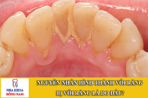 nguyên nhân hình thành vôi răng bị vôi răng là do đâu