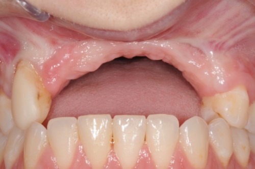 hiện tượng tiêu xương hàm khi mất răng