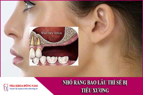 nhổ răng bao lâu thì bị tiêu xương