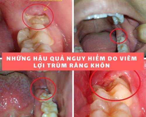 biến chứng của răng khôn