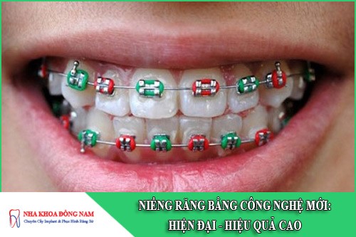 niềng răng bằng công nghệ mới hiện đại hiệu quả cao