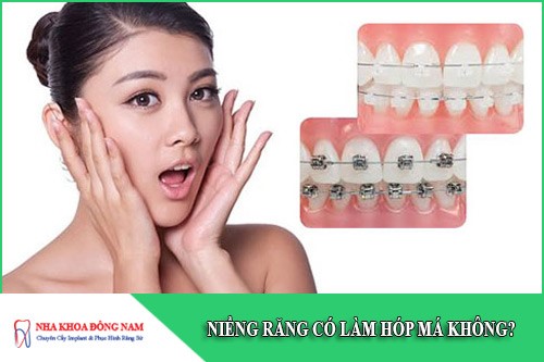 niềng răng có làm hóp má không