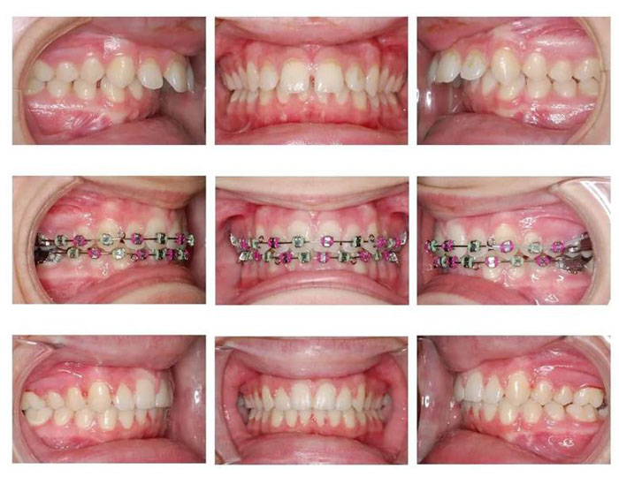 Niềng răng hô giúp bảo tồn răng thật tối ưu