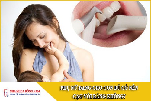 phụ nữ đang cho con bú có nên cạo vôi răng không