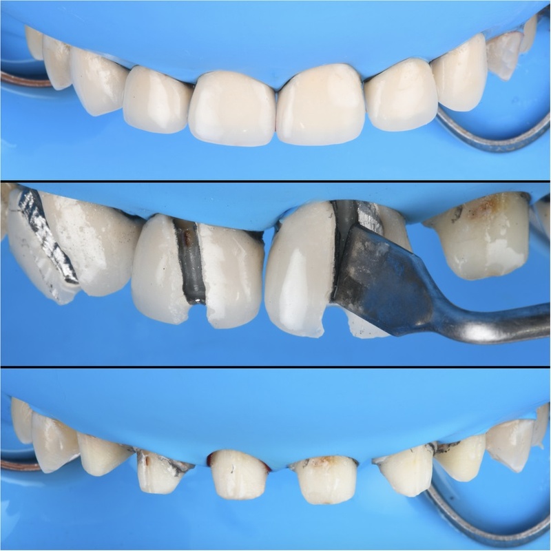 Quy trình tháo răng sứ thực hiện theo từng bước