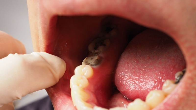 Răng bị sâu nặng viêm tủy không thể phục hồi nếu trám răng