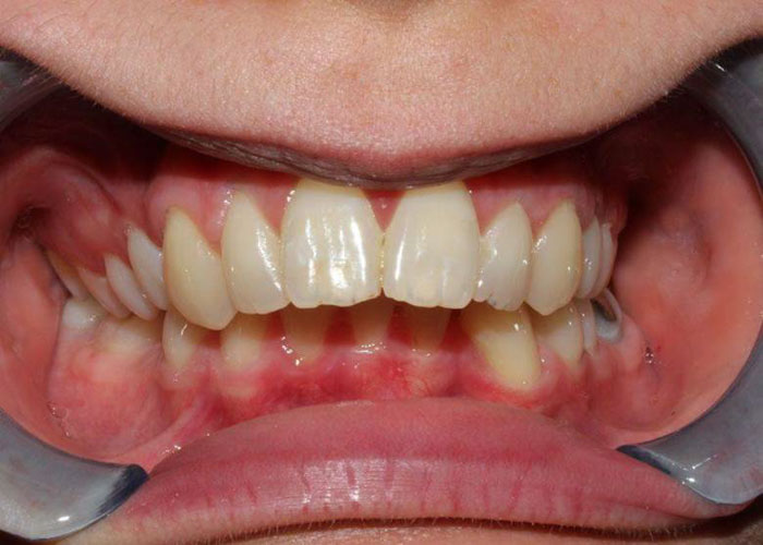 Răng hô khiến tổng thể hàm răng trông kém thẩm mỹ