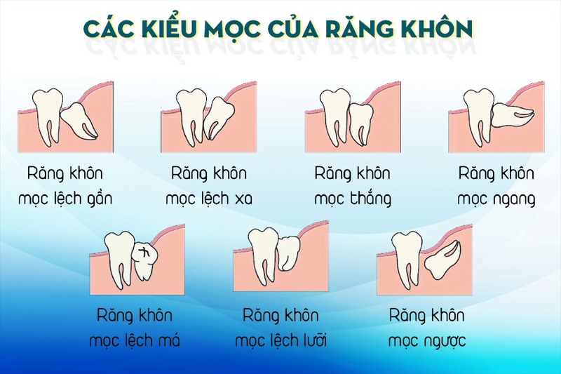 Răng khôn thường mọc lệch